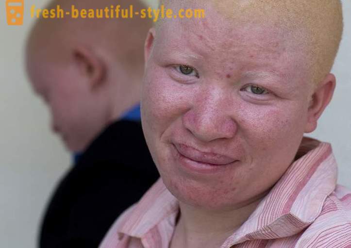 Traaginen historia Tansanian albiinojen