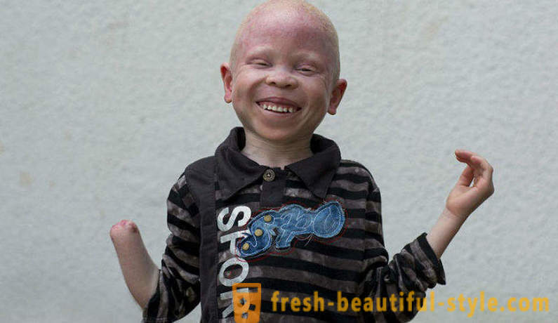 Traaginen historia Tansanian albiinojen