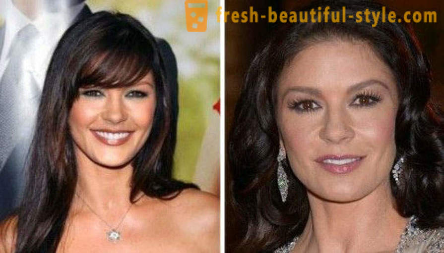 15 kuuluisuuksia, valmis huonosti Botox