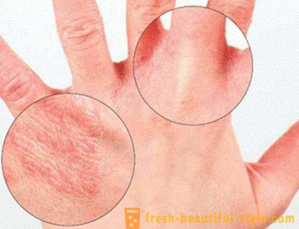 Kuiva iho käsien: Aiheuttaa. Hyvin kuiva iho, mitä tehdä?