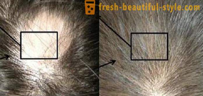 Mesoterapia hiukset: meikki työkalut ja vasta-