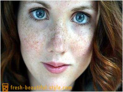 Huolehdi niiden kauneuden ja nuoriso: aiheuttaa pigmentti kasvoihin